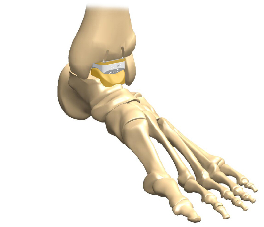 The artificial ankle joint